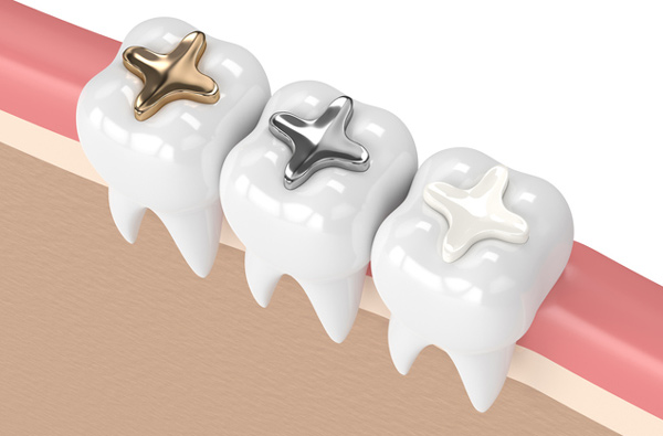 Rendering of teeth with three filling materials at Reich Dental Center – Roswell.