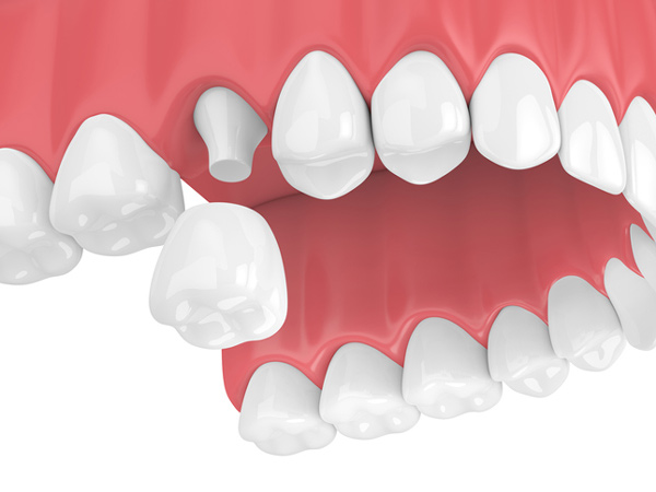 Rendering of jaw with dental crown at Reich Dental Center in Roswell, GA