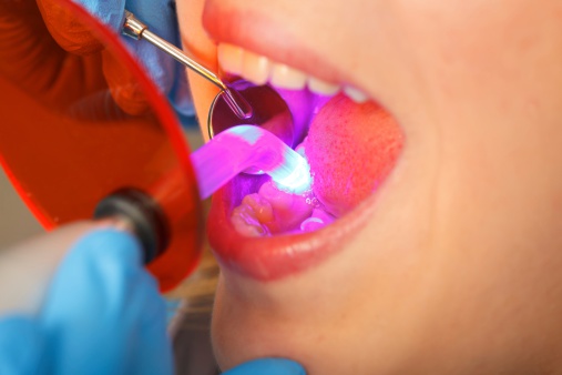 The Comprehensive Guide to Dental Bonding