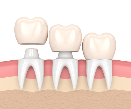 3D rendering showing the placement of a dental crown on a tooth abutment at Reich Dental Center in Smyrna, GA