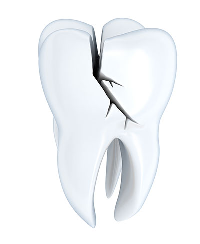 Can a General Dentist Repair a Broken Tooth?