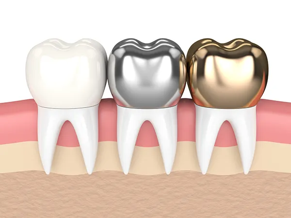3D rendered cross-section view of three teeth with dental crowns made of different materials at Reich Dental Center – Roswell in Roswell, GA