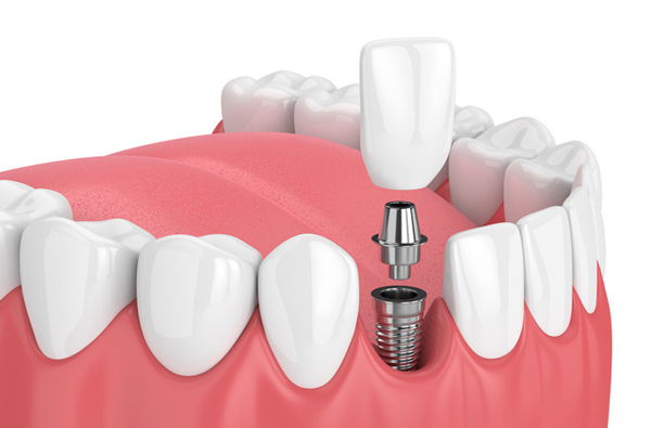 Rendering of jaw with dental implant at Reich Dental Center in Smyrna, GA 