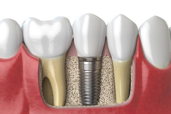 3D rendering of a dental implant next to healthy teeth at Reich Dental Center – Roswell in Roswell, GA