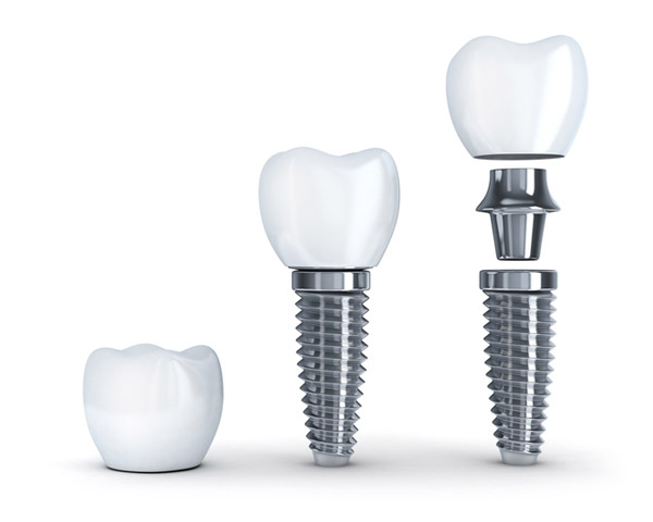 Diagram of single dental implant with post at Reich Dental Center in Smyrna, GA
