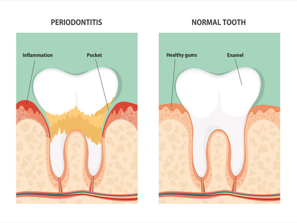 Diagram of periodontitis and health of a tooth at Reich Dental Center – Roswell.
