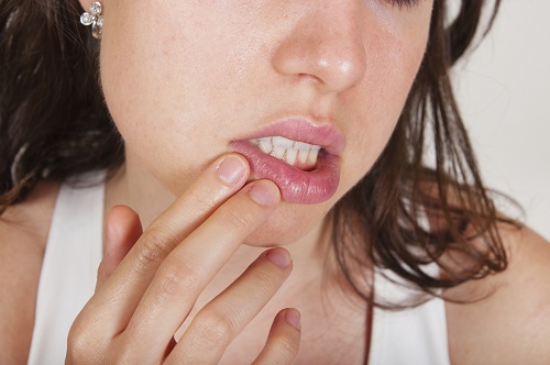 Facts About Canker Sores