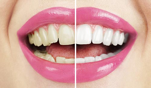 Image of a mouth before and after a teeth whitening procedure at Reich Dental Center – Roswell.