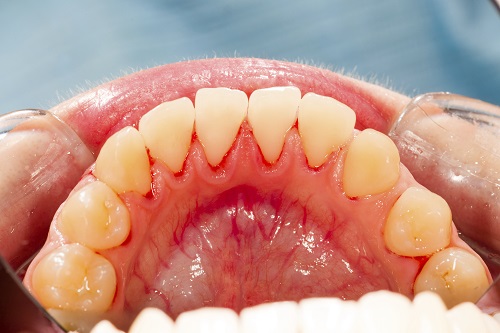 Are Dark Gums Something to Worry Yourself Over?